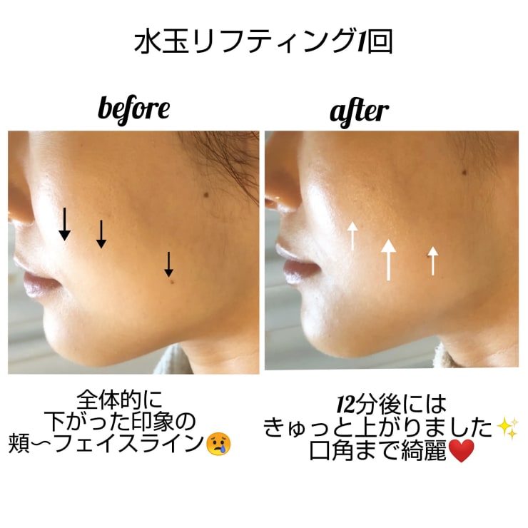お肌の救世主♪希少マシン!水玉リフティングLDM&テクスパ | 肌 お肌の救世主♪希少マシン!水玉リフティングLDM&テクスパ | 肌