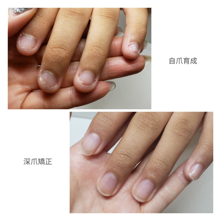 噛み爪 深爪 育成コース Before After Mins Nail ミンスネイル のこだわり特集 ネイル まつげサロン を予約するなら楽天ビューティ