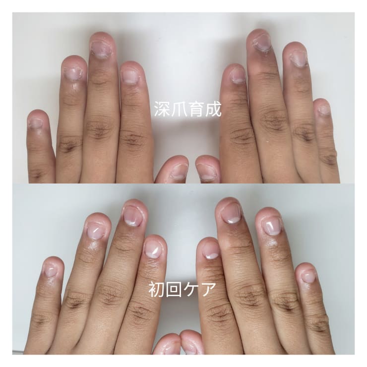 噛み爪 深爪 育成コース Before After Mins Nail ミンスネイル のこだわり特集 ネイル まつげサロンを予約するなら楽天ビューティ