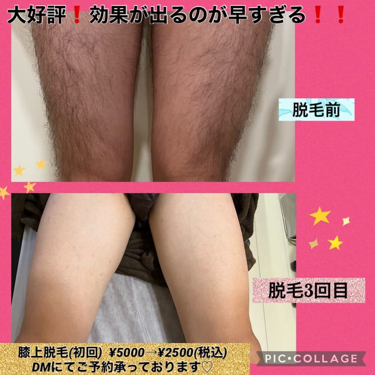 ☆【丸ごと全身脱毛(顔・VIO含む) 】が体験できるサロン☆ | 美肌脱毛