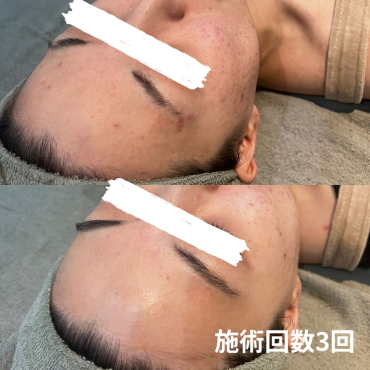 値下げハーブピーリング モナリ 顔、体にも  数十回使用できます