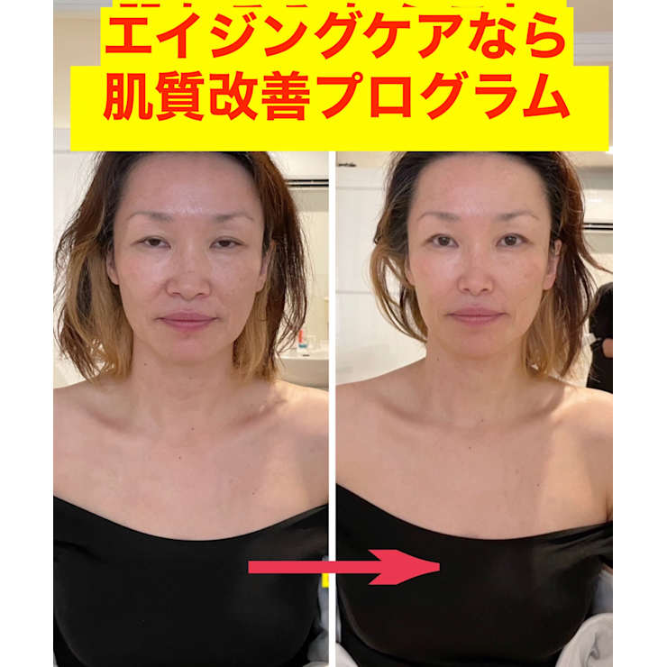 整形はイヤ でも ほうれい線 頬コケ 目元のシワ ゴルゴ線 たるみ毛穴を何とかしたいなら超オススメ たるみ専門サロン Aries アリエス タルミセンモンサロン アリエス のこだわり特集 エステサロンを予約するなら楽天ビューティ