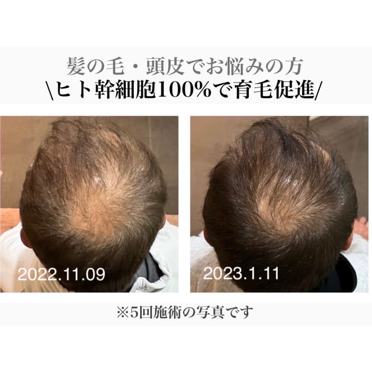 強髪】【育毛促進】【ハリ・コシ・太く・強く】ヒト幹細胞であなたの