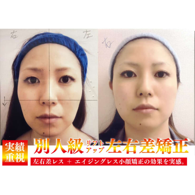 顔の左右差をなくしたい！】 | 小顔（左右差）矯正・鎖骨出し