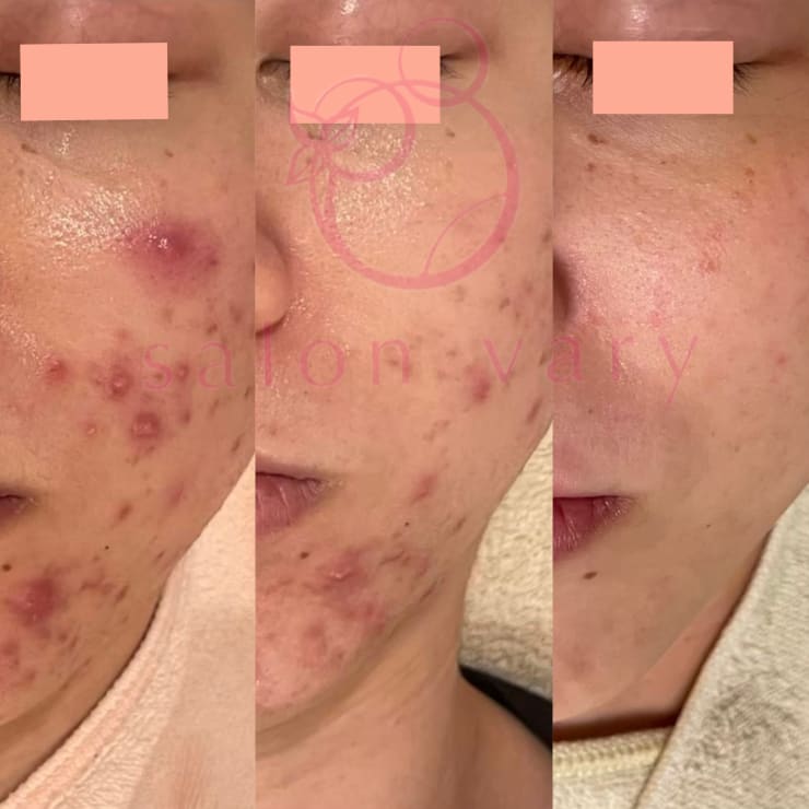 ハーブピーリングbeauty page1 C028755961.jpg?impolicy=