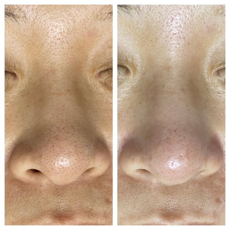 イチゴ鼻におさらば！ハイドラピーリング！水流の力で毛穴の汚れを