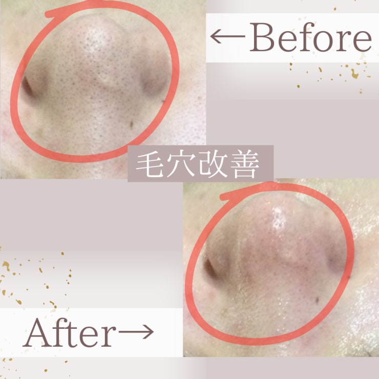 毛穴洗浄ハイドロフェイシャル×クリニック美容液導入》毛穴は絶対無視