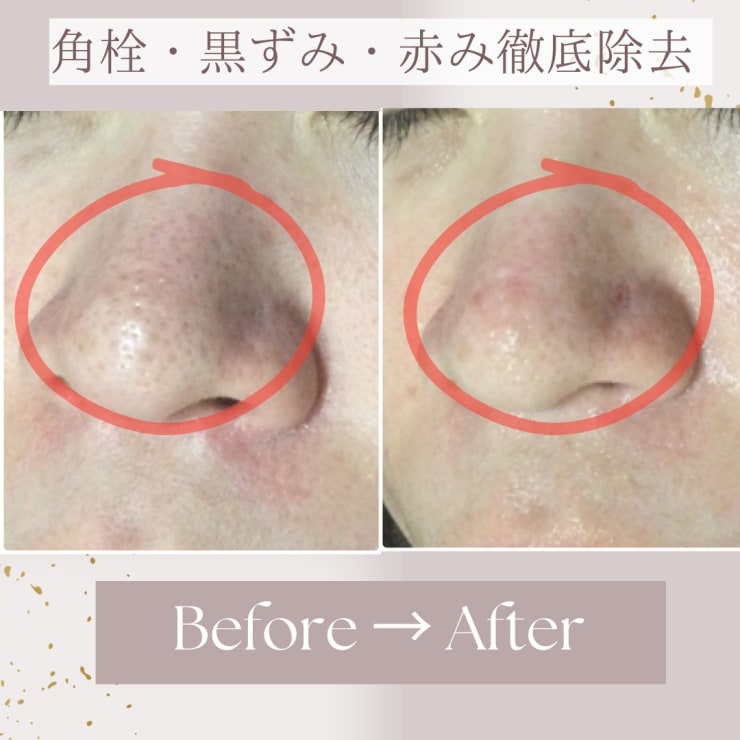 ハイドロフェイシャル　毛穴洗浄 Amazon.co.jp: ZENIX ハイドロワン ハイドラフェイシャル 毛穴洗浄