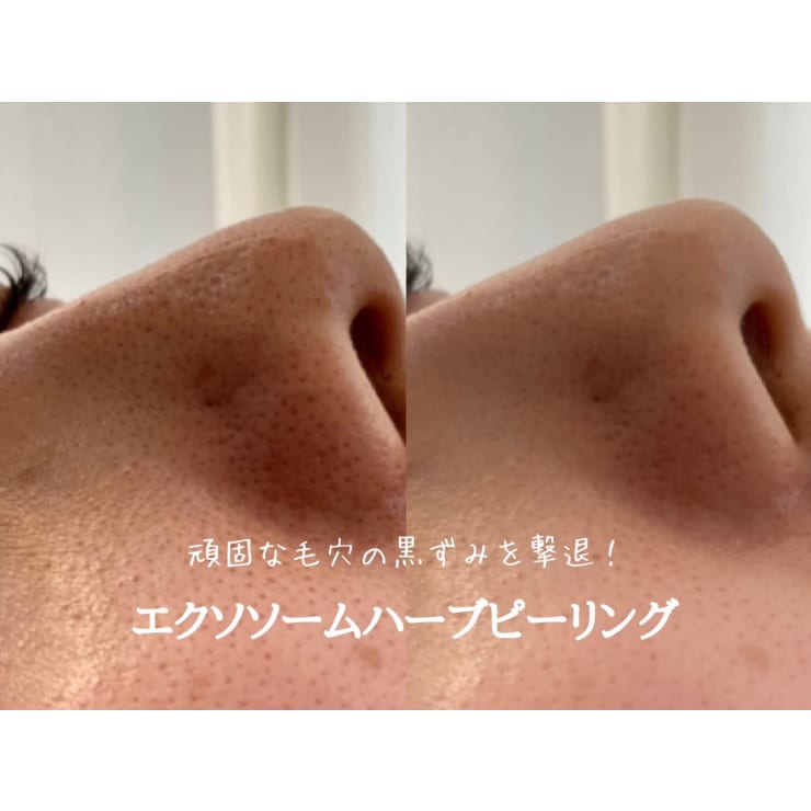 SNSで話題のエクソソームハーブピーリング☆期間限定15000円→7980円