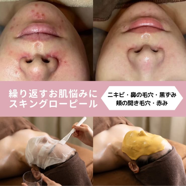 毛穴エステ 込900円 2Way 毛穴吸引機 バキューム美顔器 スプレー美顔器 毛穴 毛穴