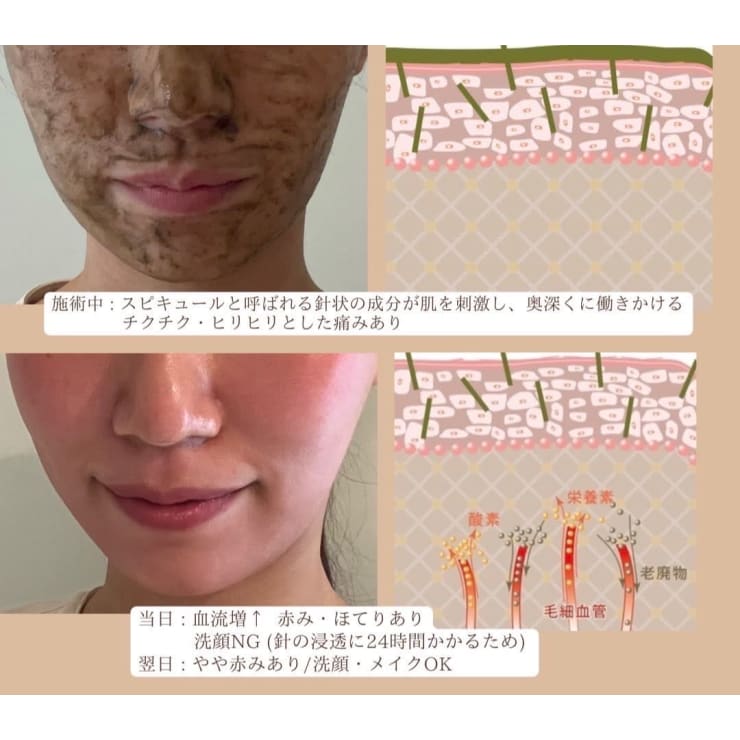 商品画像：ダーマスキンピーリング｜BQCELLの口コミ - ダウンタイムがある 1
