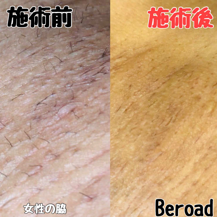 白髪・脱毛・育毛の実際 医療脱毛】白髪は脱毛できるのか？白髪のメカニズム、原因とは