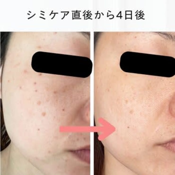 シミケア直後は？ダウンタイムは？ | シミケア 肌質改善エステ