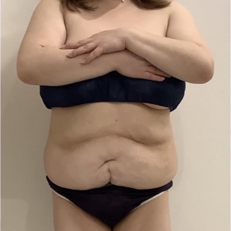 同時4箇所可能な【脂肪冷却】クリニック同様の大型マシンは脂肪を破壊