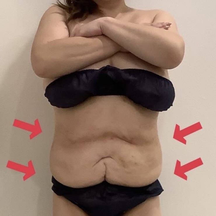 同時4箇所可能な【脂肪冷却】クリニック同様の大型マシンは脂肪を破壊