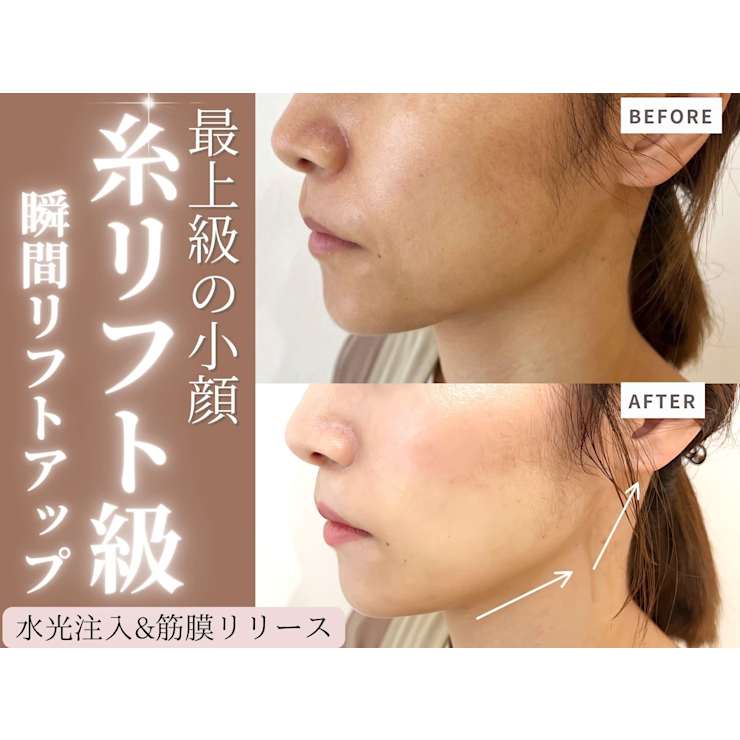 高満足度◎美容以上レベルと噂の針を使わない水光肌プラズマシャワーで