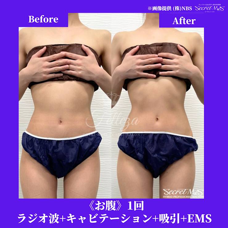 ラジオ波×キャビで叶える美ボディ＆美肌特集」 | Felleza新潟 エステ