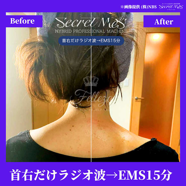 ラジオ波×キャビで叶える美ボディ＆美肌特集」 | Felleza新潟 エステ