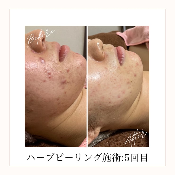繰り返すニキビにハーブピーリングが◎ | M.riche(エムリシェ)の