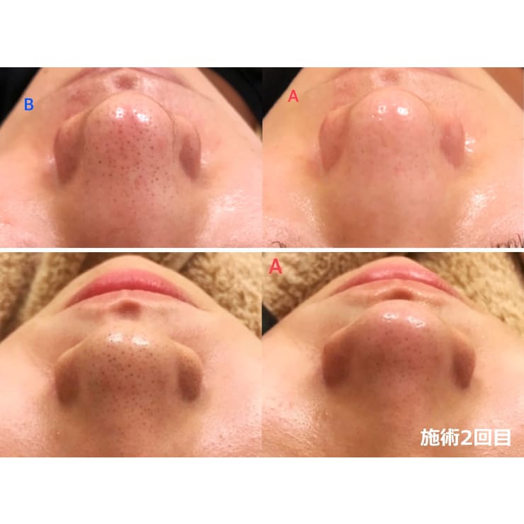 ビフォーアフター【美肌再生脱毛：顔脱毛＋フェイシャル】 | 顔脱毛
