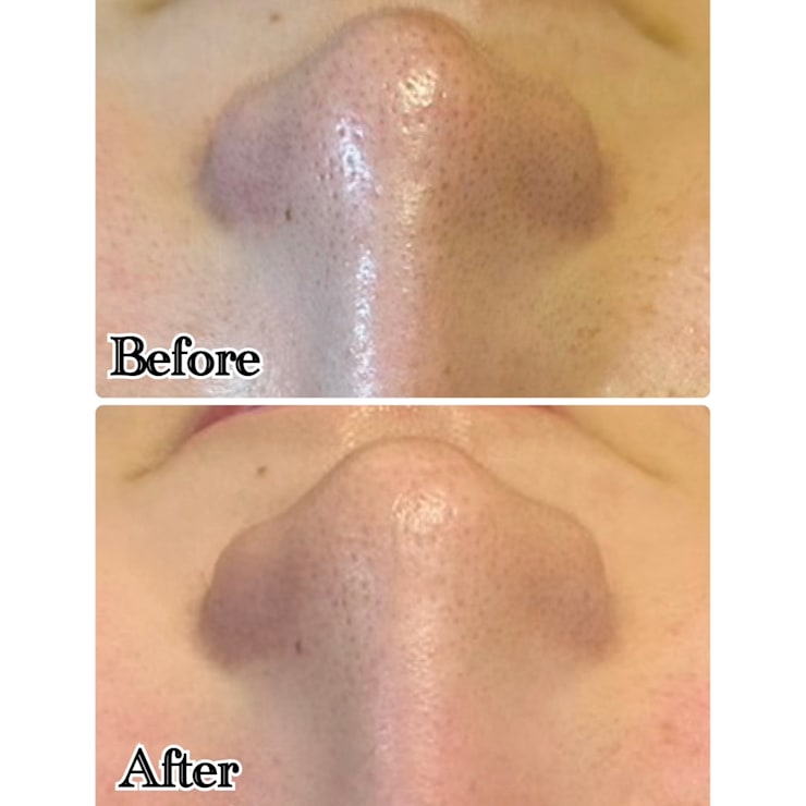 人気メニュー♪♪【毛穴洗浄】ハイドラシャインフェイシャル×極上