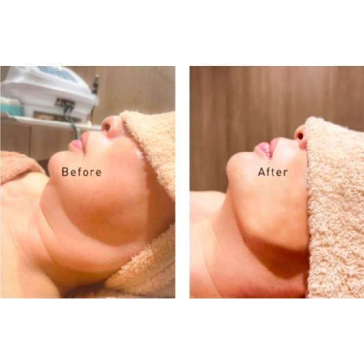 韓国発！脂肪溶解レモンボトルで二重アゴ、口横ポニョ、頬の脂肪