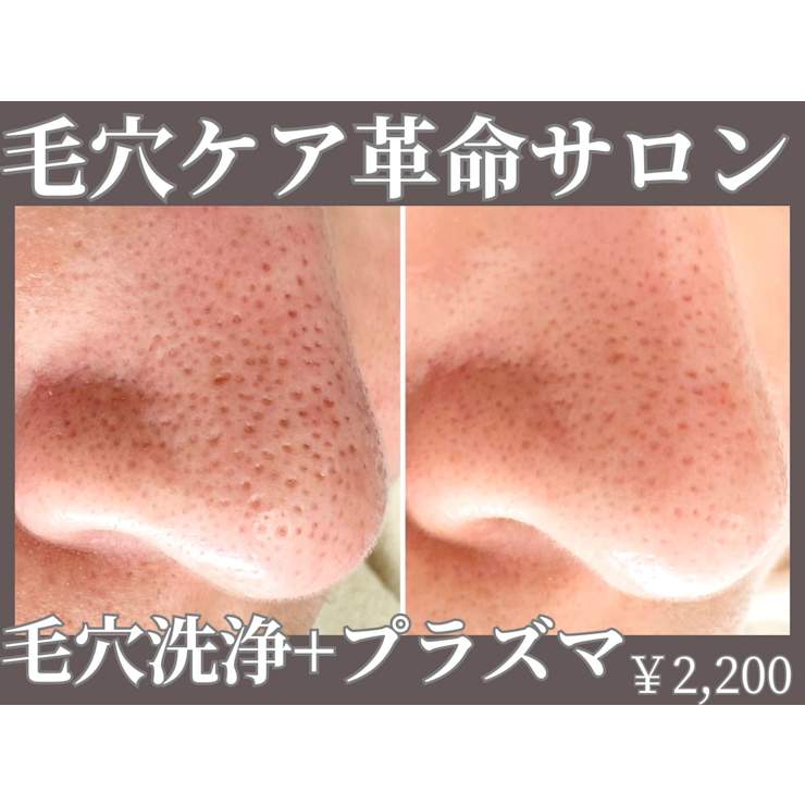 高満足度◎美容以上レベルと噂の針を使わない水光肌プラズマシャワーで