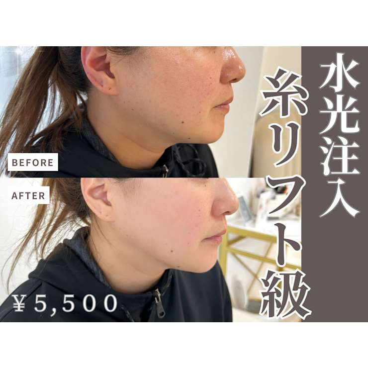 高満足度◎美容以上レベルと噂の針を使わない水光肌プラズマシャワーで