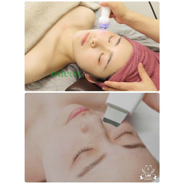 毛穴洗浄＆ハイパーナイフEX小顔 | mieux beauty salon 新小岩店