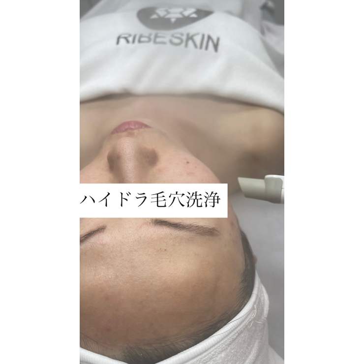 毛穴の黒ずみ・詰まりに◎水光肌叶えるハイドラ洗浄 | BeautySalonMuse