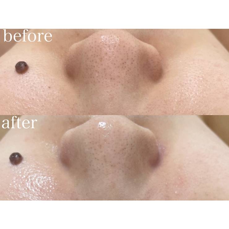 毛穴の黒ずみ・詰まりに◎水光肌叶えるハイドラ洗浄 | BeautySalonMuse