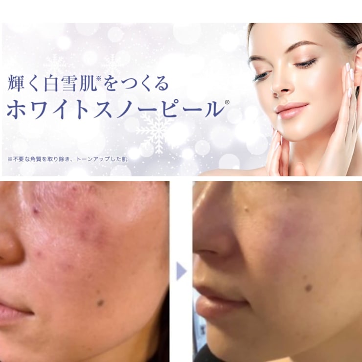 くすみやシミの改善、肌の滑らかさ《ホワイトニング 乳酸ピーリング