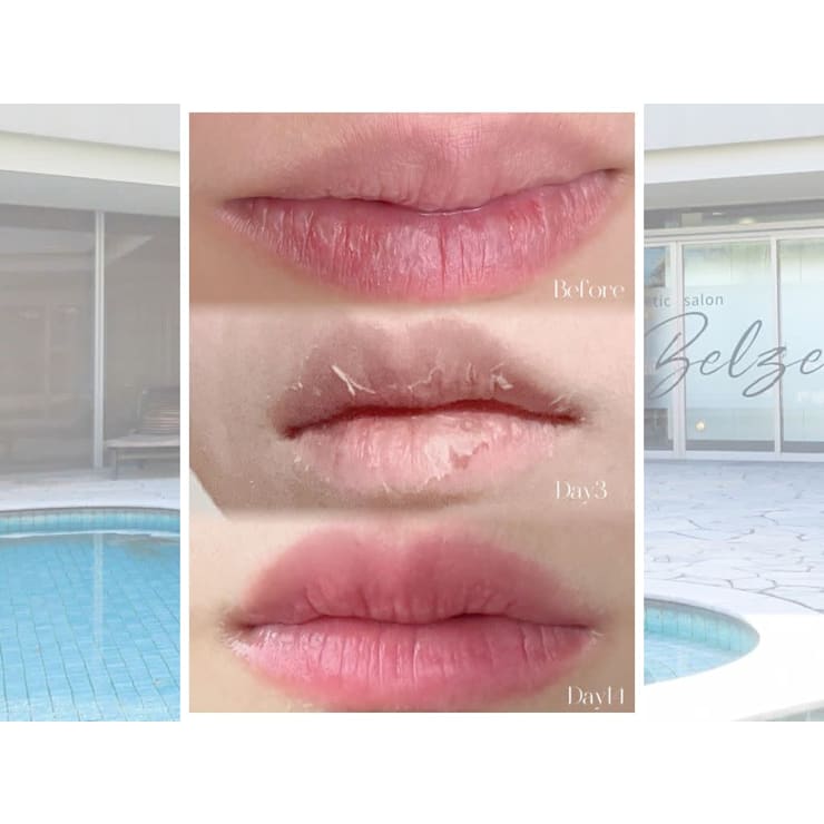 ローマピンク大人気！】ノンケミカル美容セラム×LEDで悩める黒ずみに