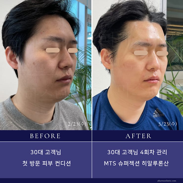 ⭐️まとめ売り！お買い得！⭐️スーパージェクション　superjection SUPERJECTION/スーパージェクション – Pharmesthetic JAPAN