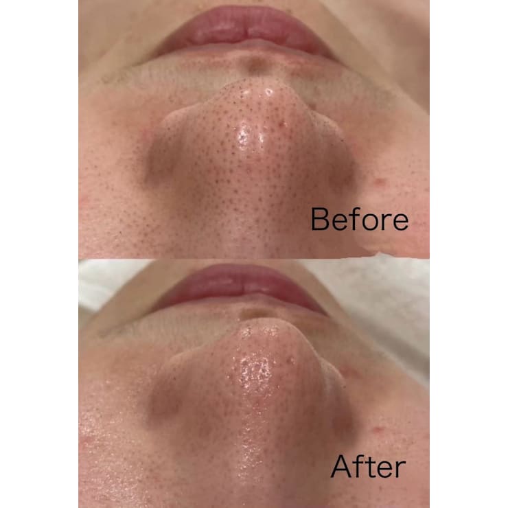 人気メニュー♪♪【毛穴ごっそり洗浄】ハイドラシャイン毛穴洗浄+極上