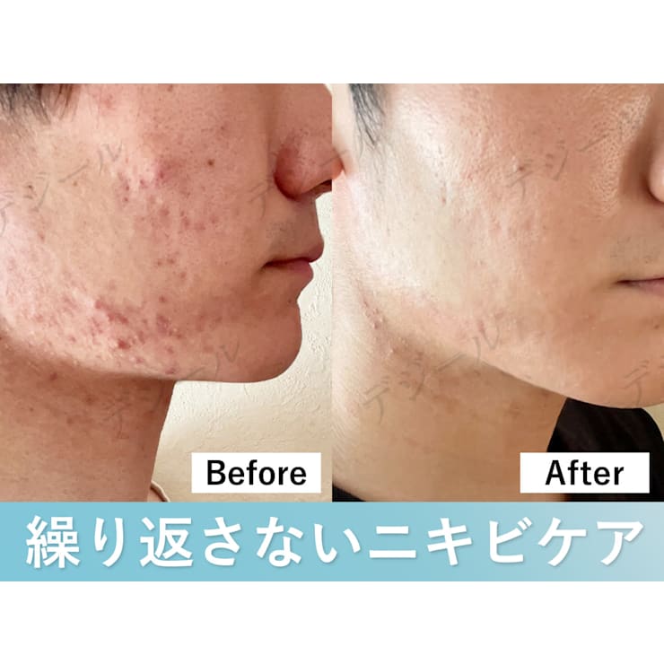 繰り返すしつこいニキビ】根本から改善！プラズマフェイシャル