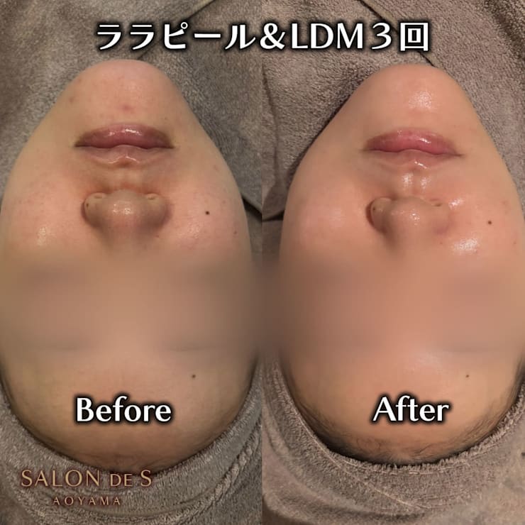 最新韓国式肌管理ララピール×LDM！毛穴レスな水光肌へ導く、痛みなしの