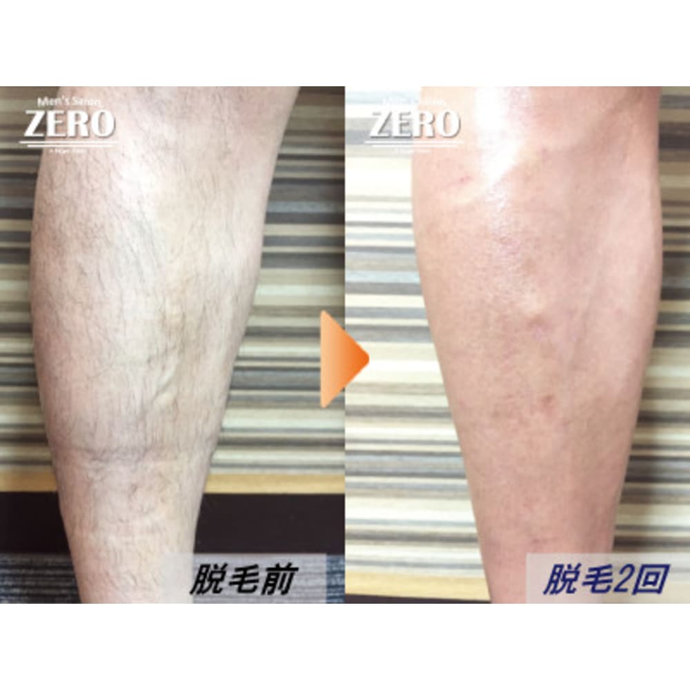 Men S Salon Zero心斎橋 お客様脱毛写真 Men S Salon Zero心斎橋店 メンズサロンゼロ のこだわり特集 エステサロンを予約するなら楽天ビューティ Men S Salon Zero心斎橋 お客様脱毛写真 Men S Salon Zero心斎橋店 メンズサロンゼロ のこだわり特集 エステサロンを予約するなら楽天ビューティ