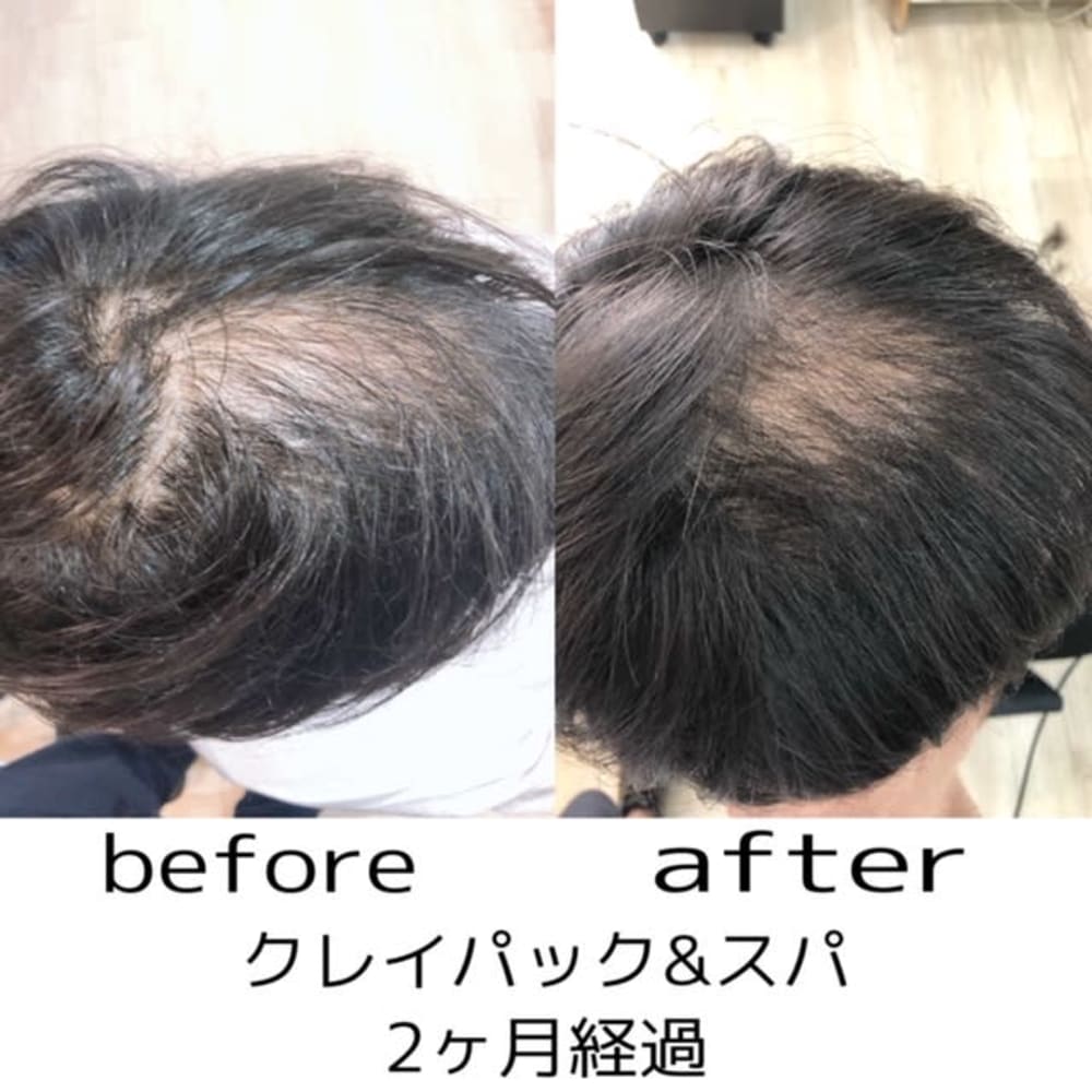 アクティバート ヒト幹細胞培養液使用 ヘッドスパの変化 Hairsalon Trigger ヘアーサロントリガー のヘアスタイル 美容院 美容室を予約するなら楽天ビューティ アクティバート ヒト幹細胞培養液使用 ヘッドスパの変化 Hairsalon Trigger ヘアーサロントリガー のヘアスタイル 美容院 美容室を予約するなら楽天ビューティ