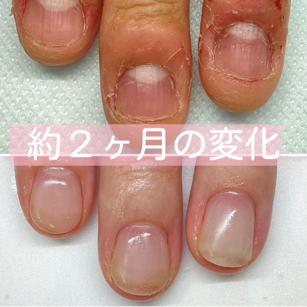 深爪 自爪育成 脱毛サロン elle& 画像