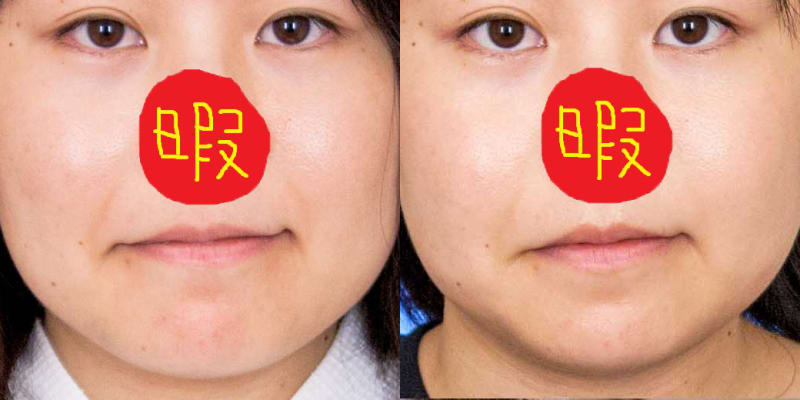施術前と施術後の比較画像ですね。こうやって並べると違いが一目で分かるから凄いですね!