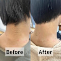 メンズうなじ脱毛