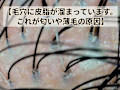 頭皮に皮脂があり、赤みなどの炎症もある頭皮写真　よくないです
