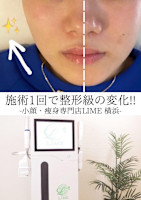 Vライン 形成(ブイライン ケイセイ)