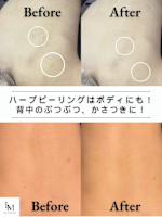 夏前！背中 ニキビケア(セナカ ニキビケア)