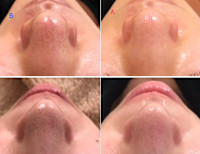 美療顔脱毛＋4種類の特許フェイシャル（毛穴）(ケアナ)