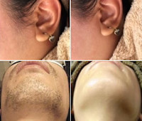 美療顔脱毛(カオダツモウ)