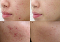 美療顔脱毛＋4種類の特許フェイシャル（ニキビ）(ニキビ)