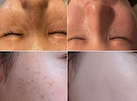 美療顔脱毛＋4種類の特許フェイシャル（シミ）(シミ)