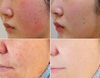 美療顔脱毛＋4種類の特許フェイシャル（赤ら顔）(アカラガオ)